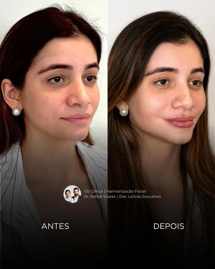 Antes e depois: harmonização feminina
