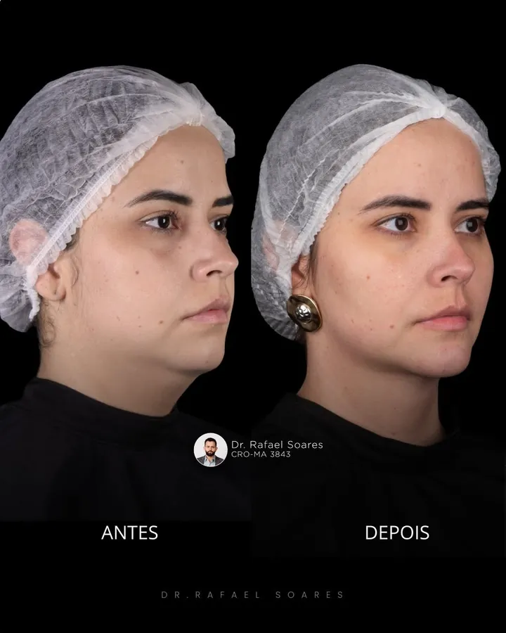 Antes e depois: papada, contorno e olheiras