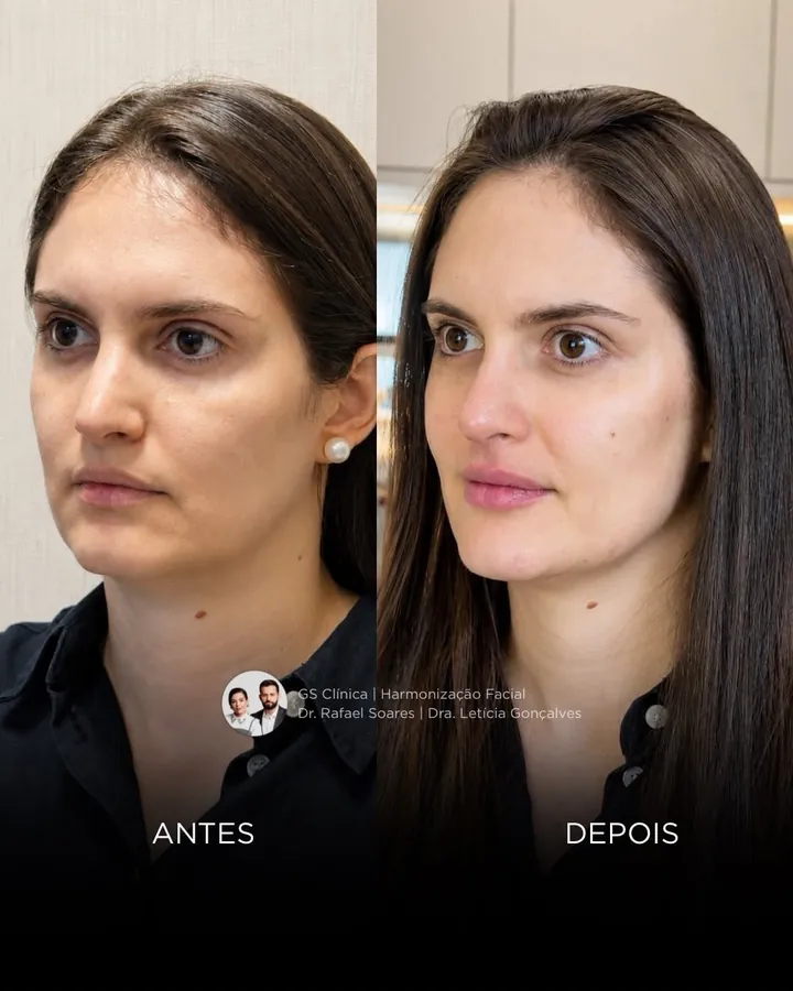Antes e depois: sustentação facial e perfil