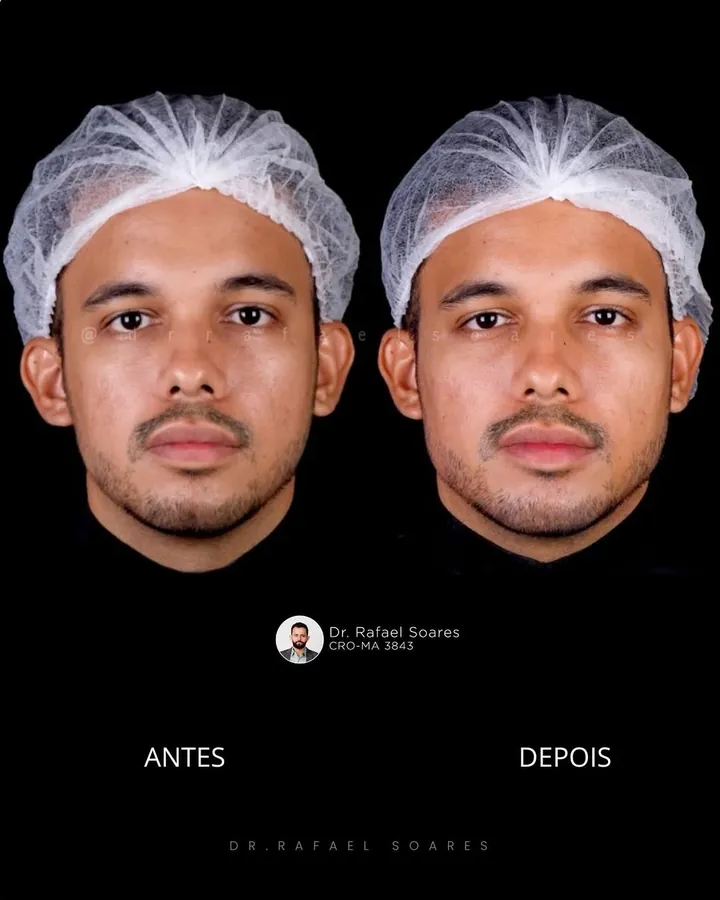 Antes e depois: falta de contorno masculino
