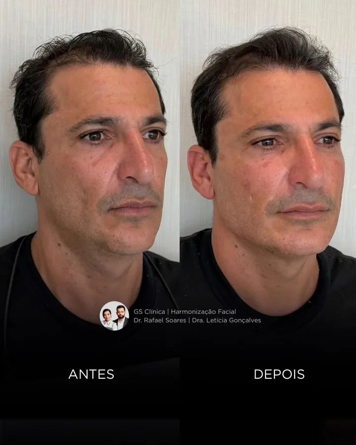 Antes e depois: rosto masculino após emagrecimento